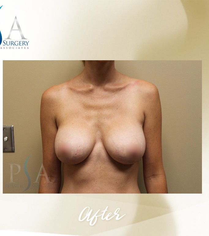 Corrective Breast Surgeries before and after - after