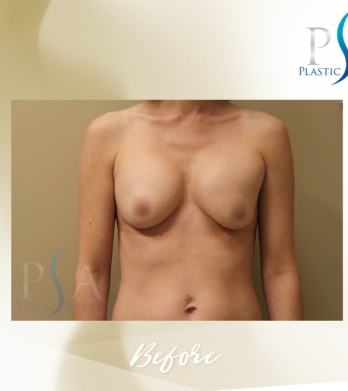 Corrective Breast Surgeries before and after - before