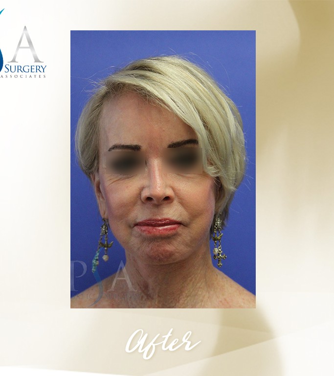 Face Lift before and after - after