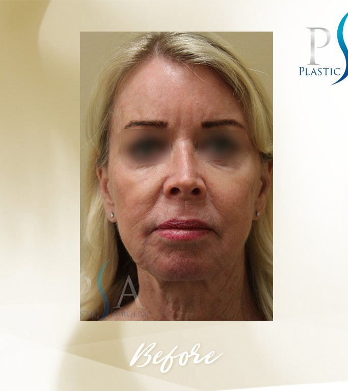 Face Lift before and after - before