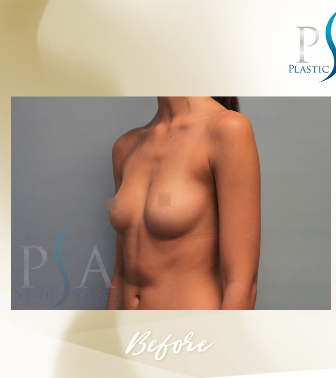 Breast Augmentation before and after - before