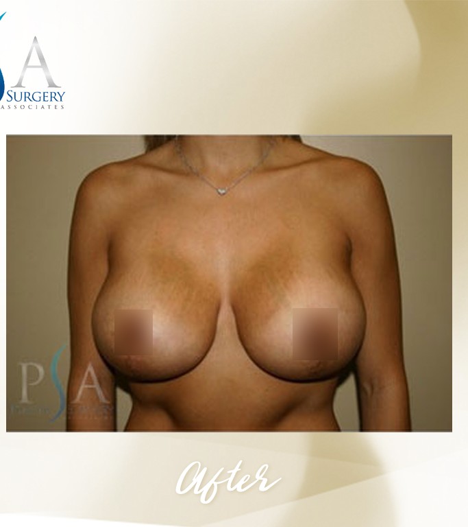 Breast Augmentation / Mastopexy before and after - after