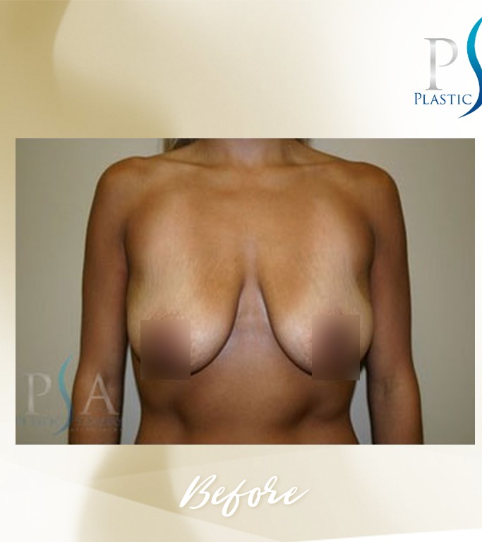 Breast Augmentation / Mastopexy before and after - before