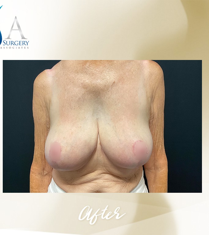Breast Implant Removal with Breast Reduction before and after - after