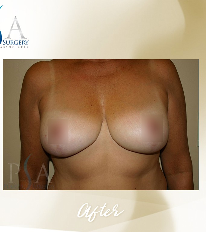 Breast Reduction before and after - after