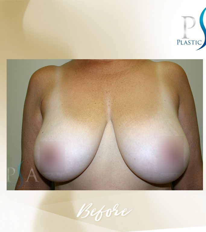 Breast Reduction before and after - before