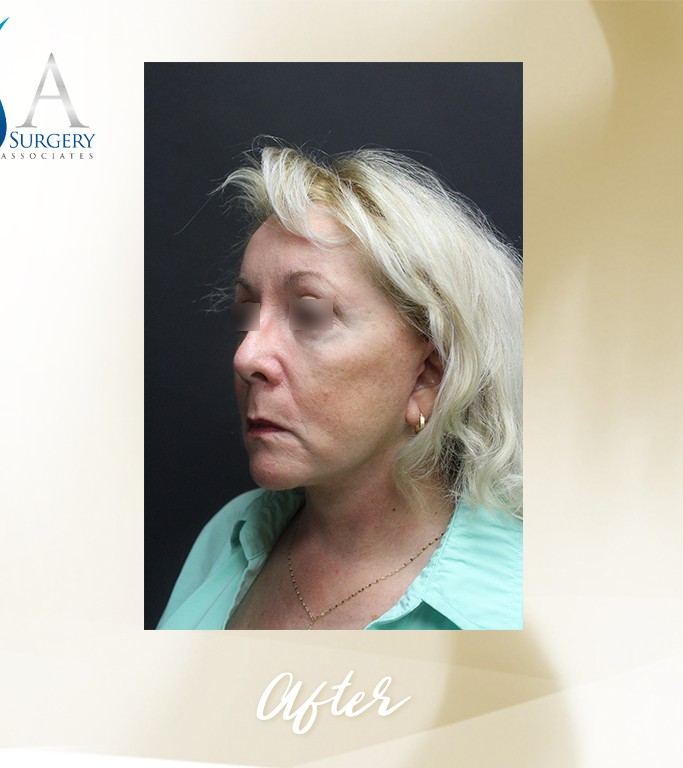 Face Lift before and after - after