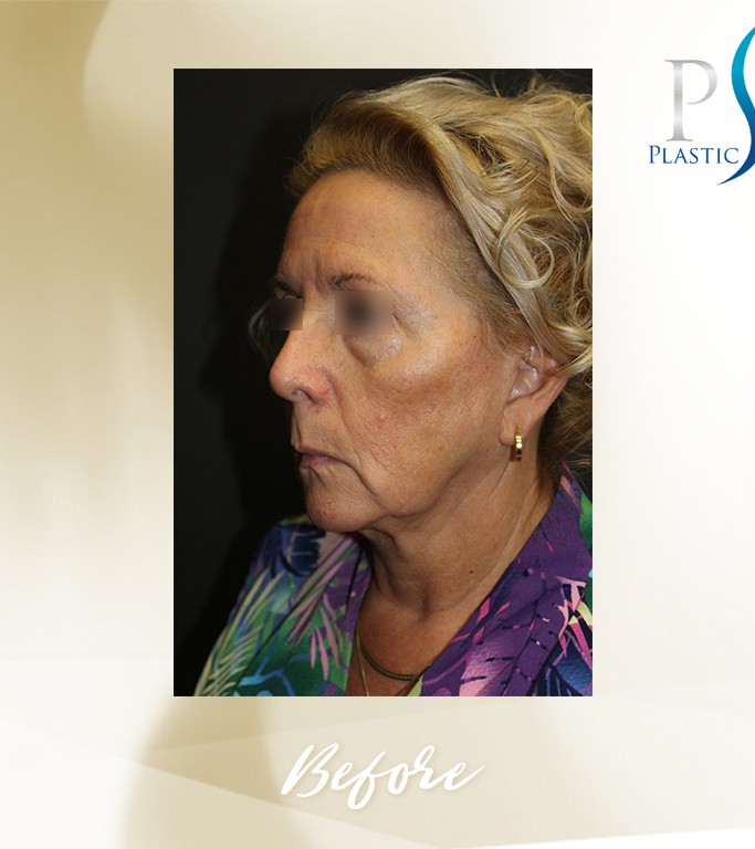 Face Lift before and after - before
