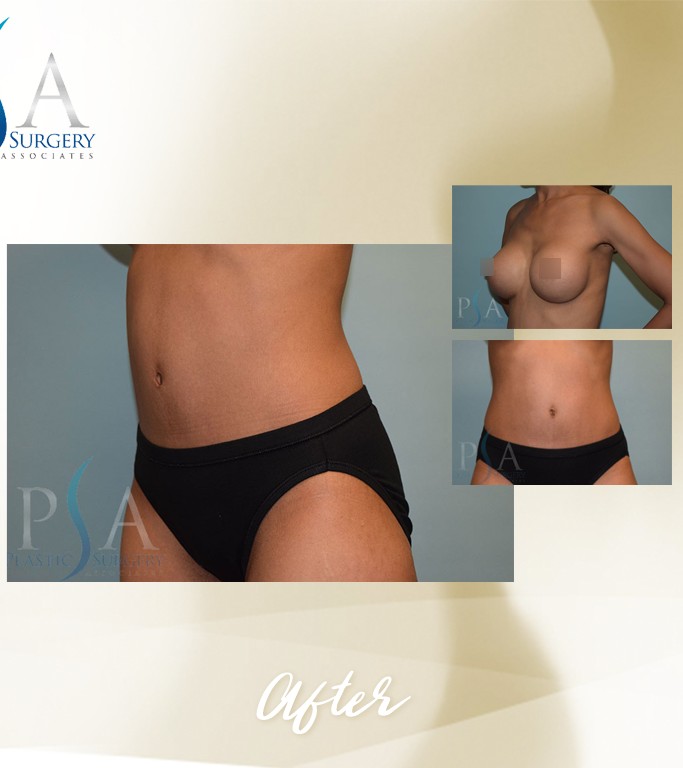 Mommy Makeover before and after - after