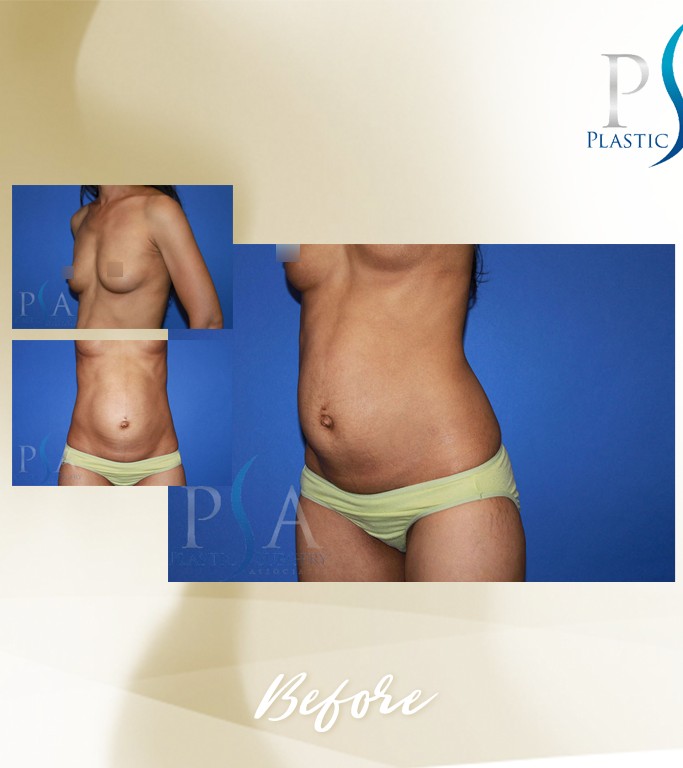 Mommy Makeover before and after - before
