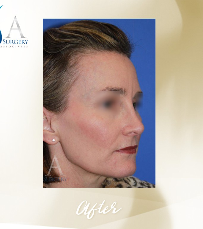 Rhinoplasty before and after - after