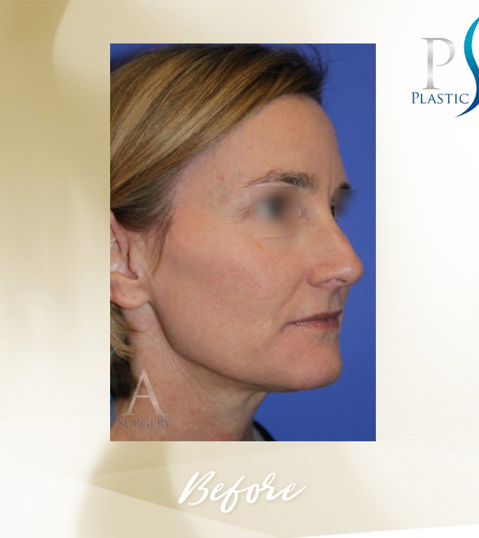 Rhinoplasty before and after - before