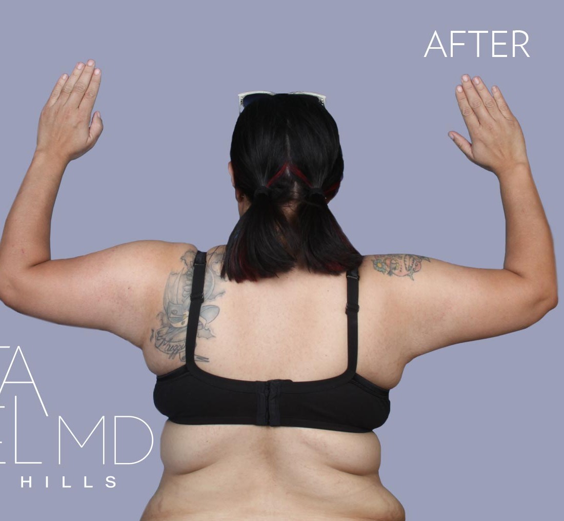 Arm Lift before and after - after