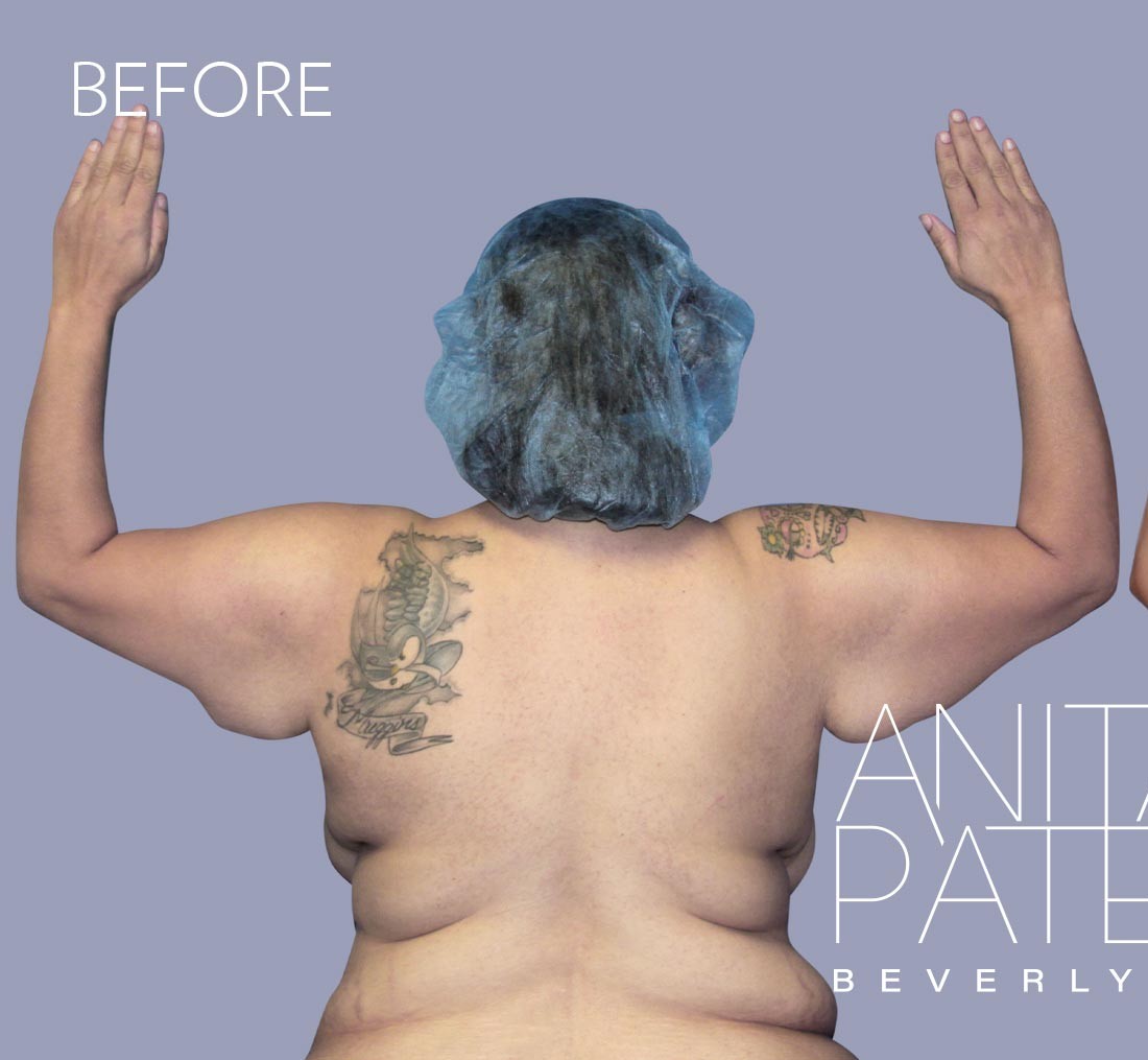 Arm Lift before and after - before