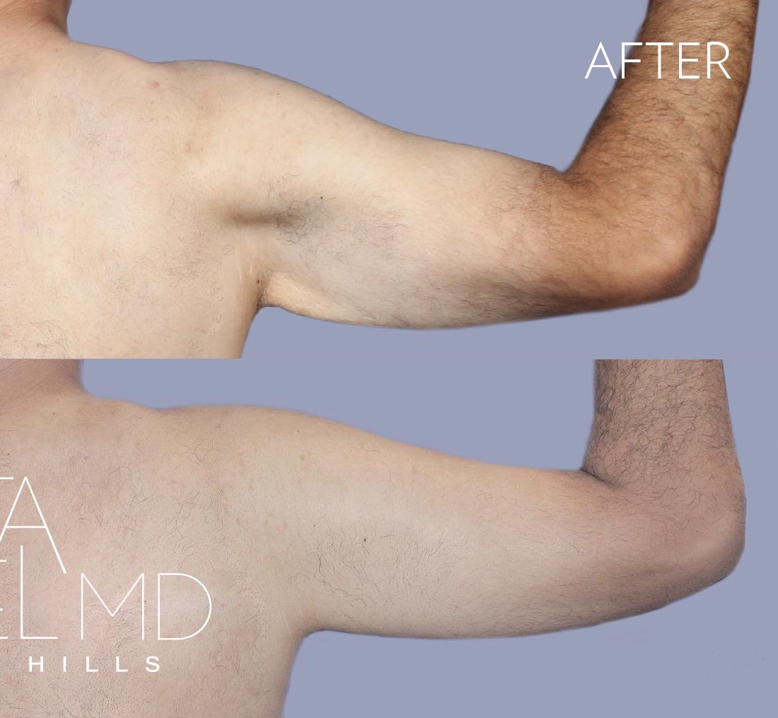 Arm Lift before and after - after