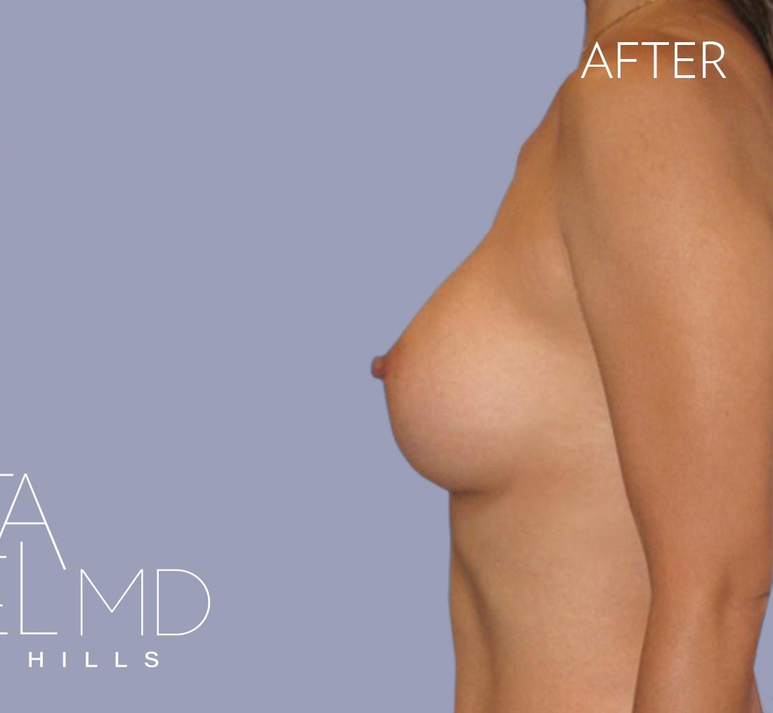 Breast Augmentation before and after - after