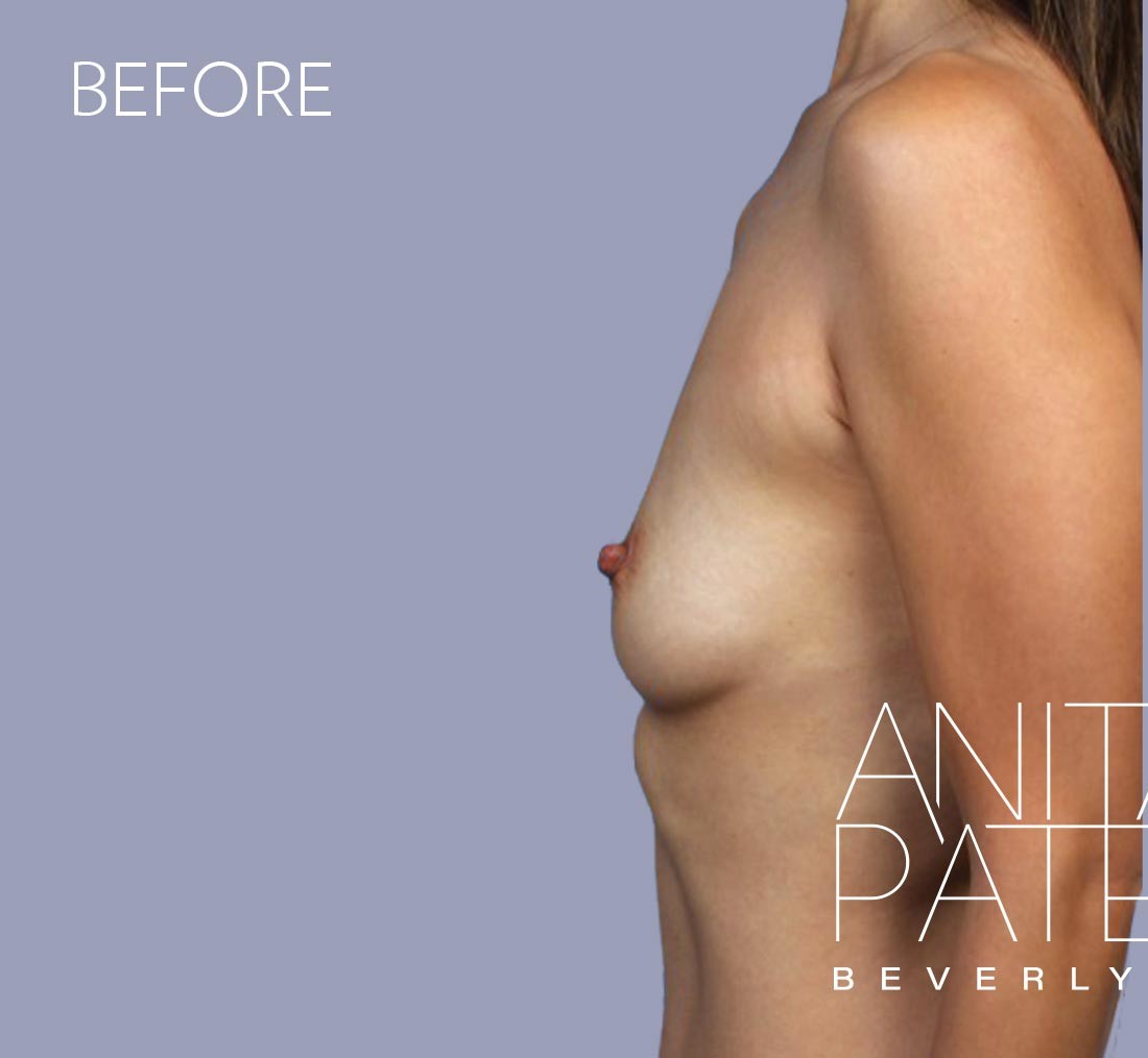 Breast Augmentation before and after - before