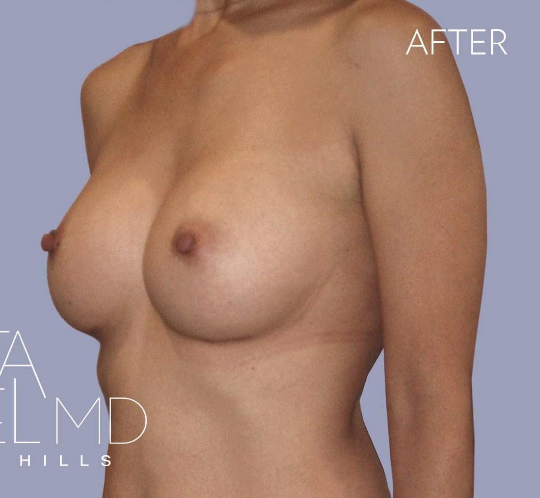 Breast Augmentation before and after - after