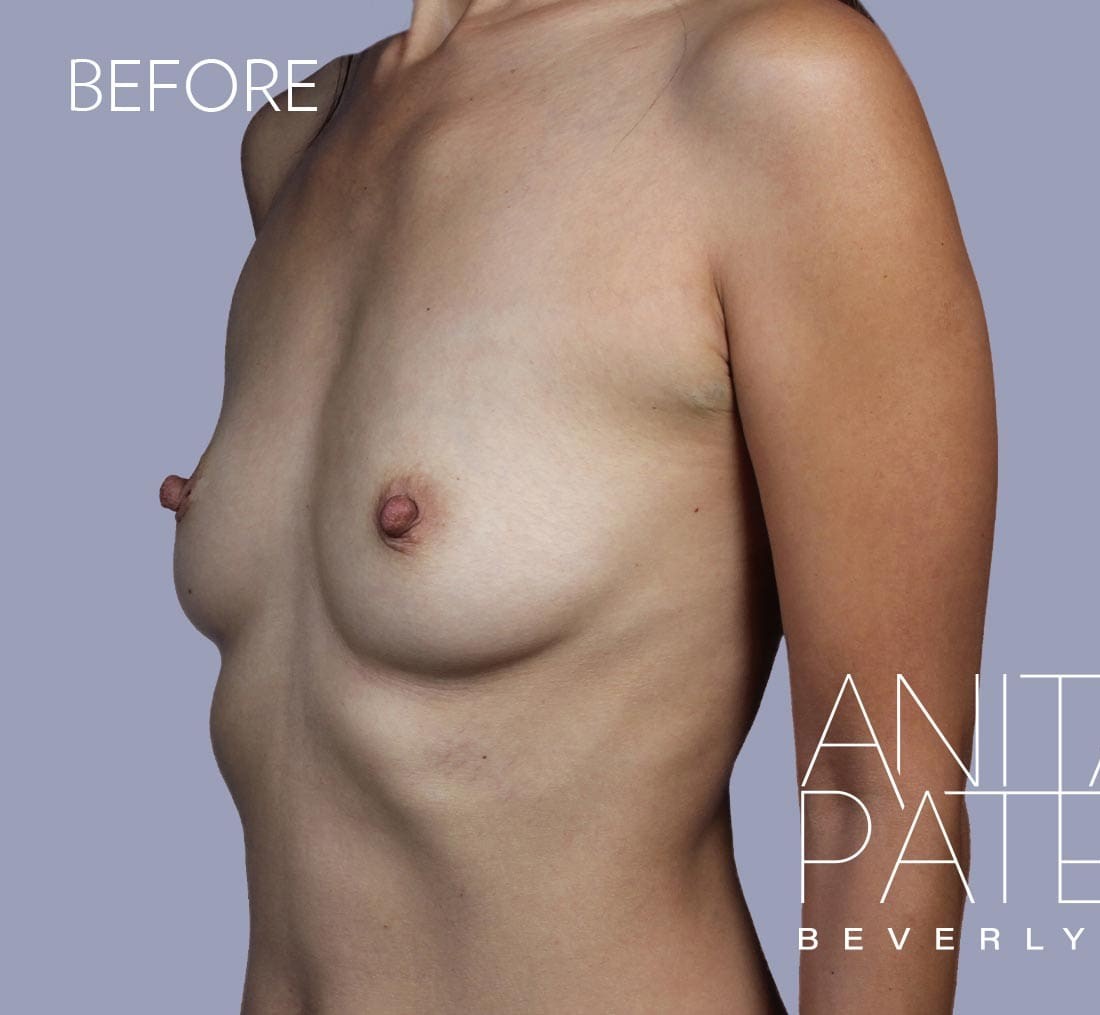 Breast Augmentation before and after - before