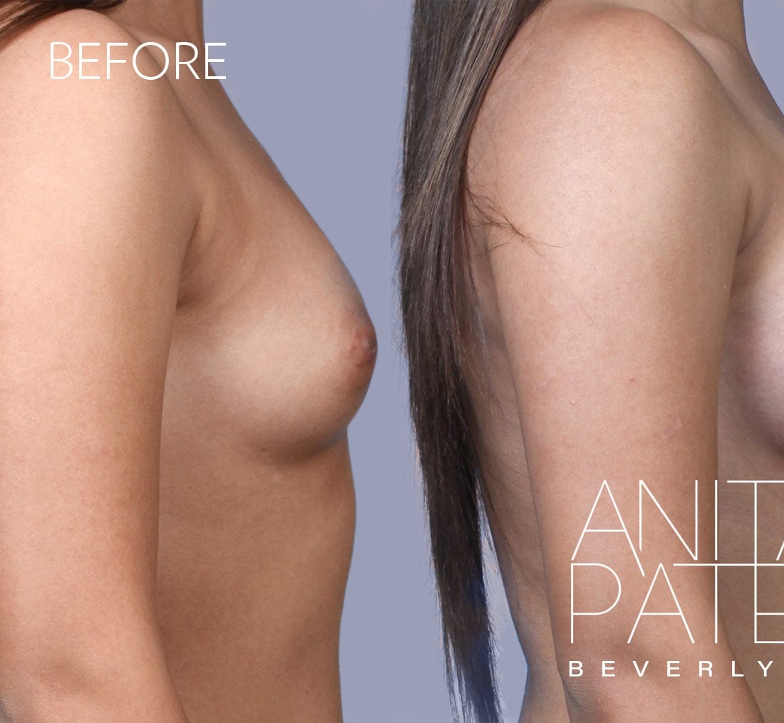 Breast Augmentation before and after - before