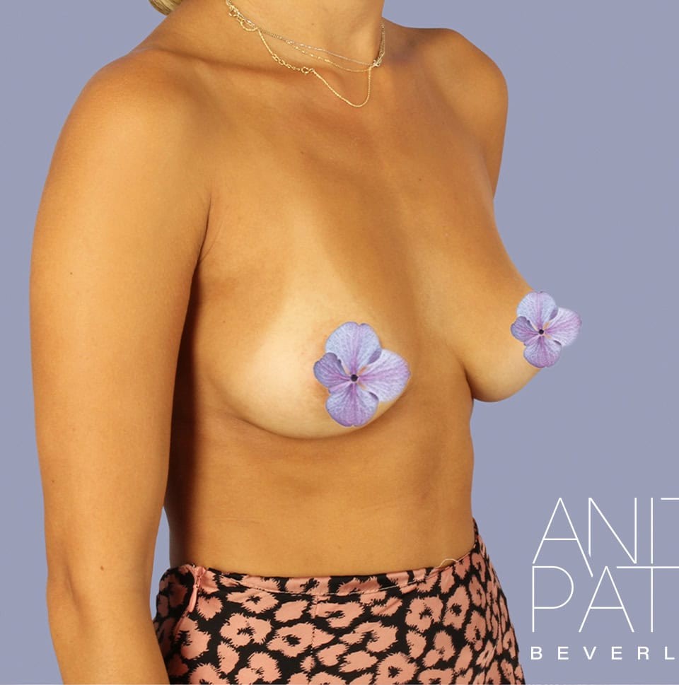 Breast Augmentation before and after - before