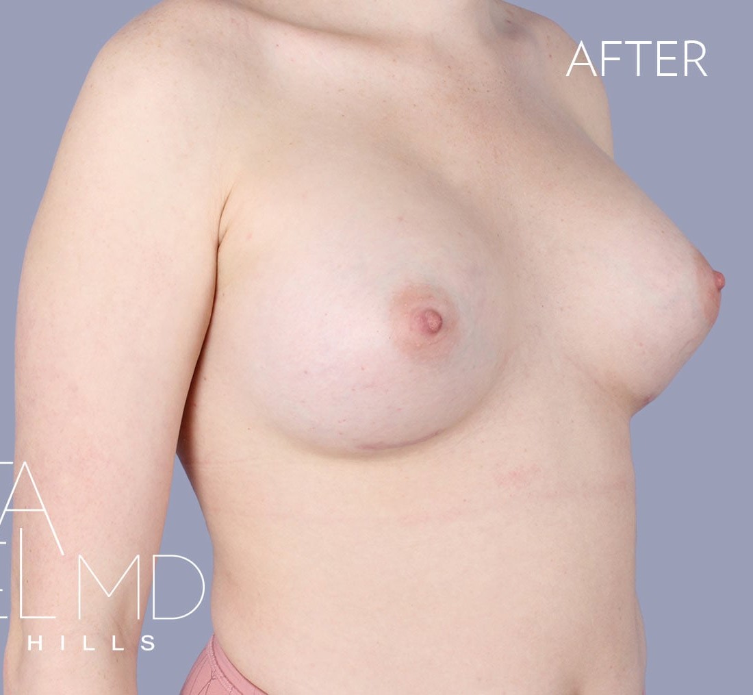 Breast Augmentation before and after - after