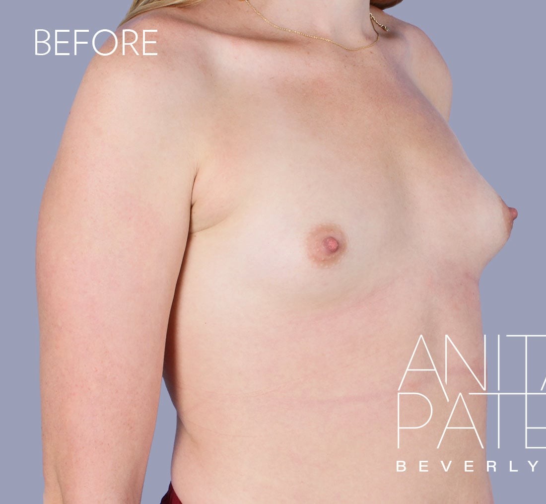 Breast Augmentation before and after - before