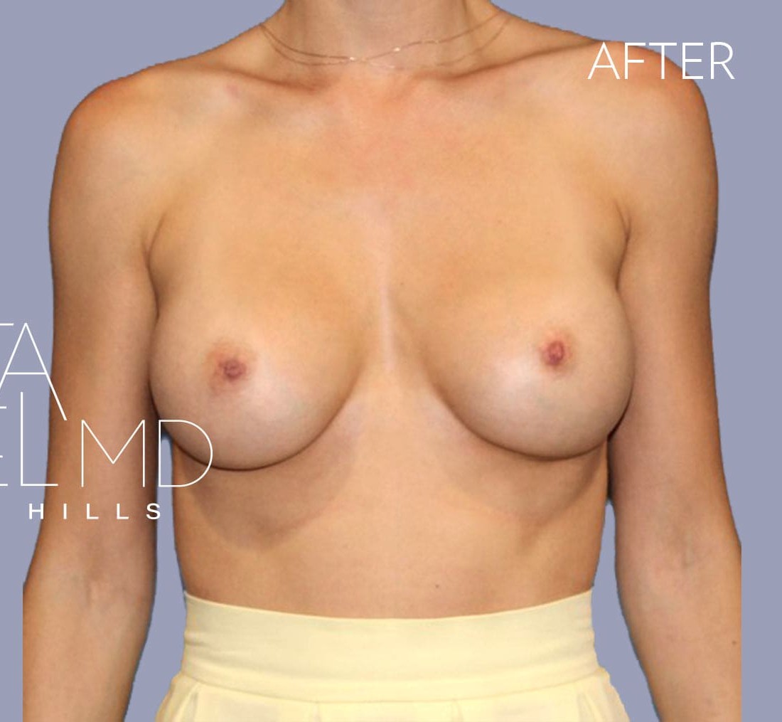 Breast Augmentation before and after - after