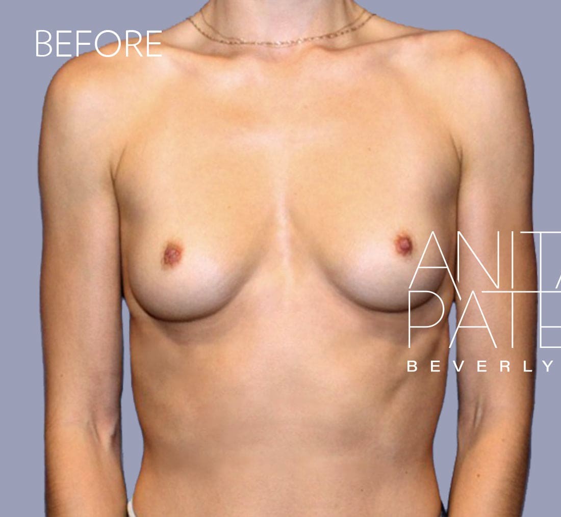 Breast Augmentation before and after - before