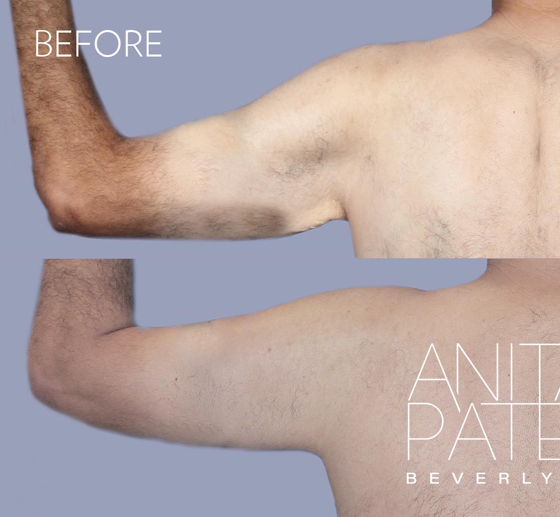 Arm Lift before and after - before