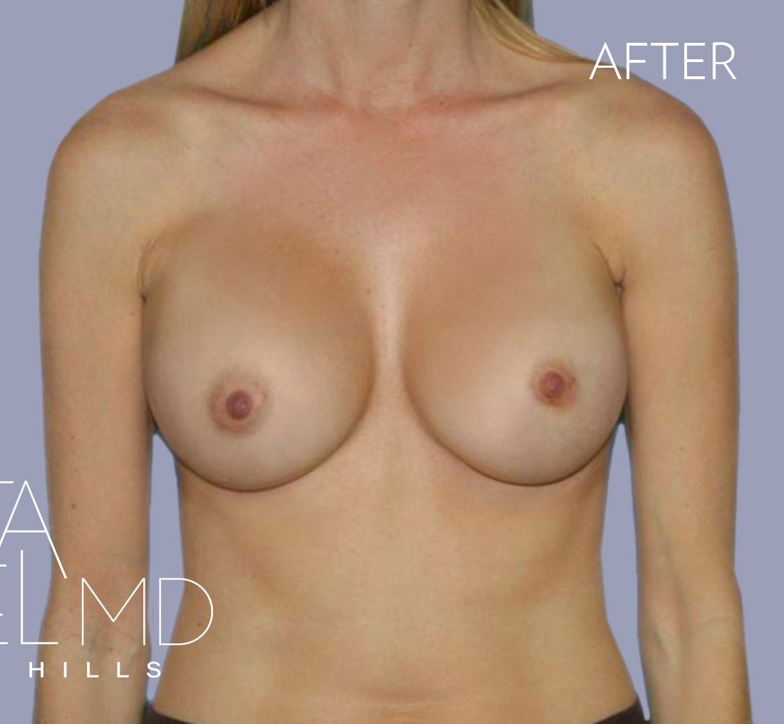 Breast Augmentation before and after - after