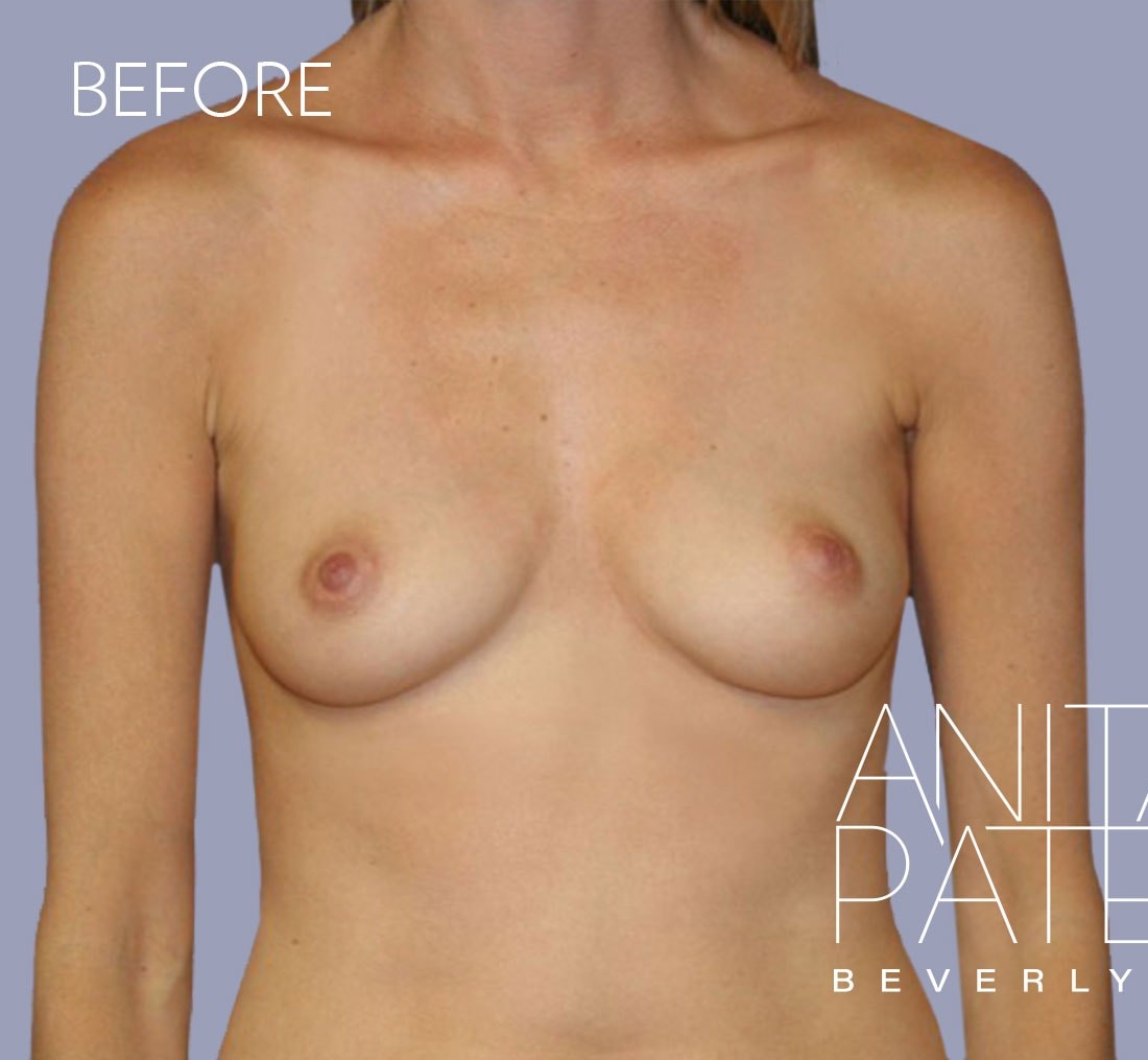 Breast Augmentation before and after - before