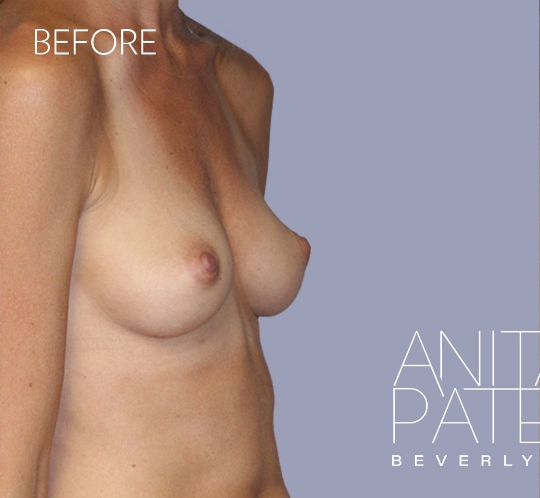 Breast Augmentation before and after - before
