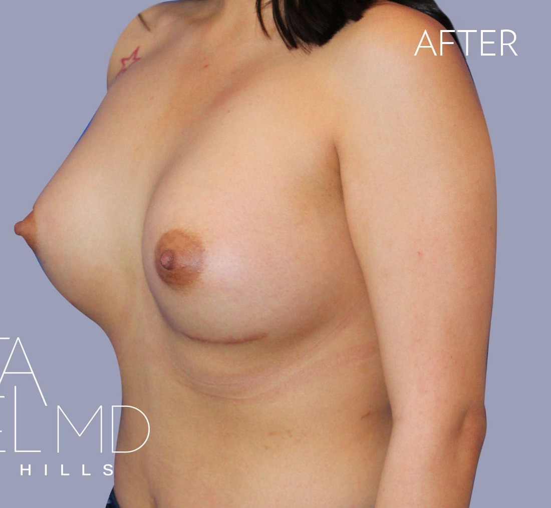 Breast Augmentation before and after - after