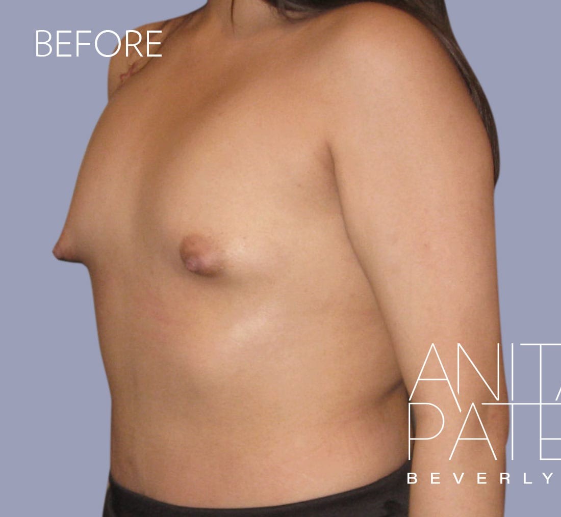 Breast Augmentation before and after - before