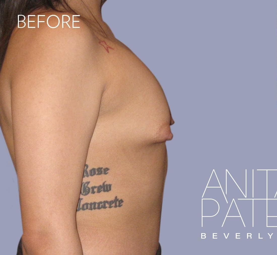 Breast Augmentation before and after - before