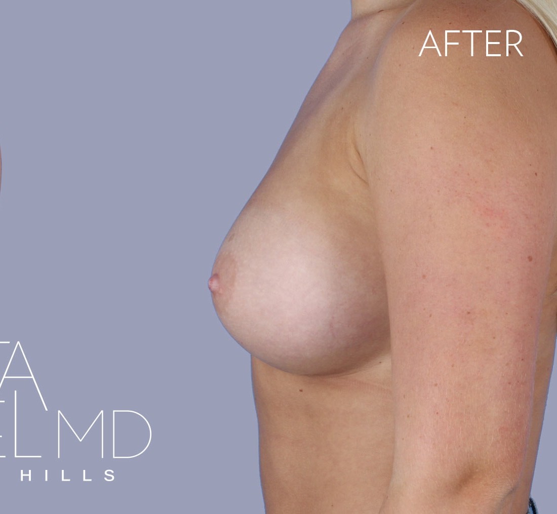 Breast Augmentation before and after - after