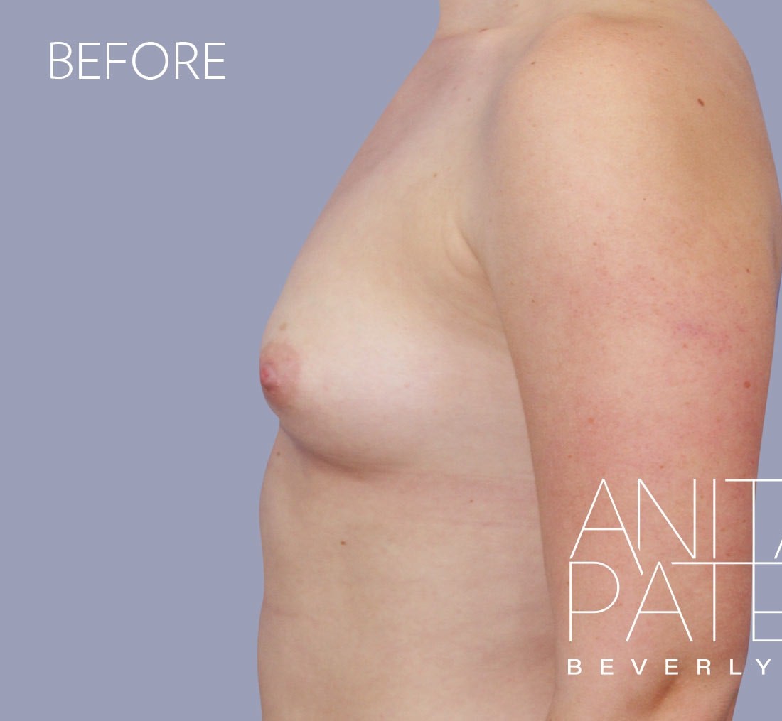 Breast Augmentation before and after - before