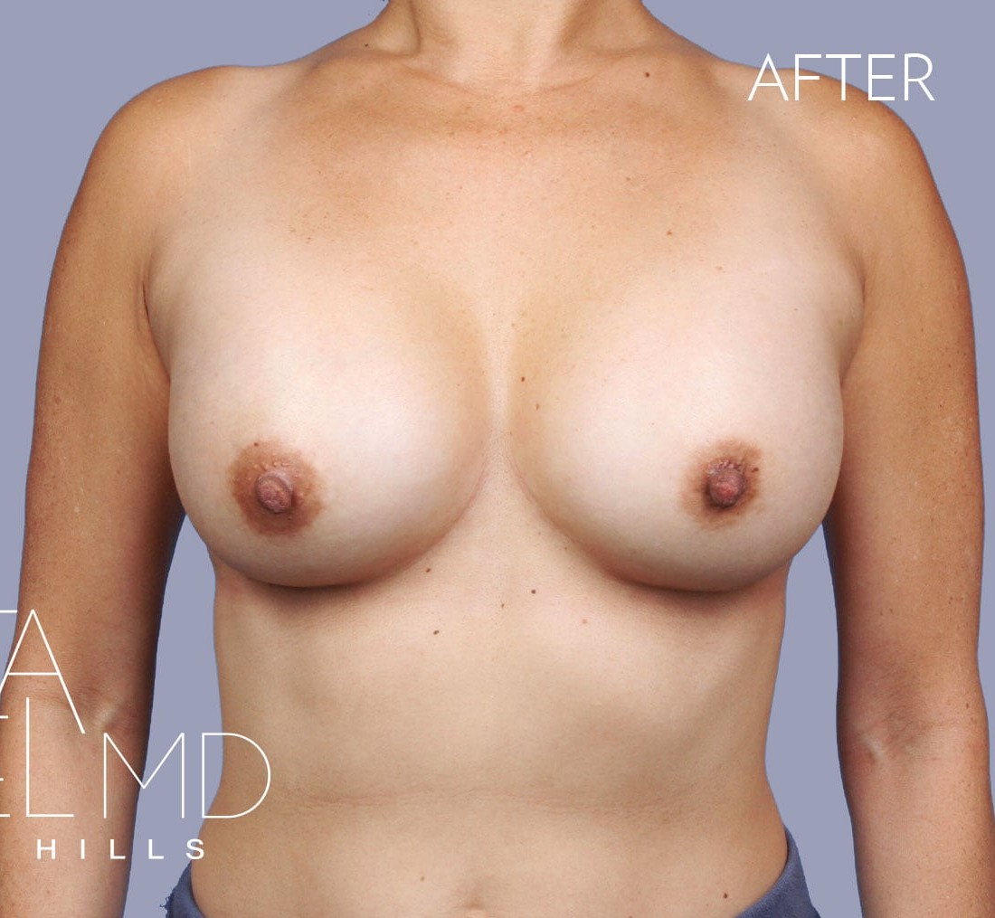 Breast Augmentation before and after - after