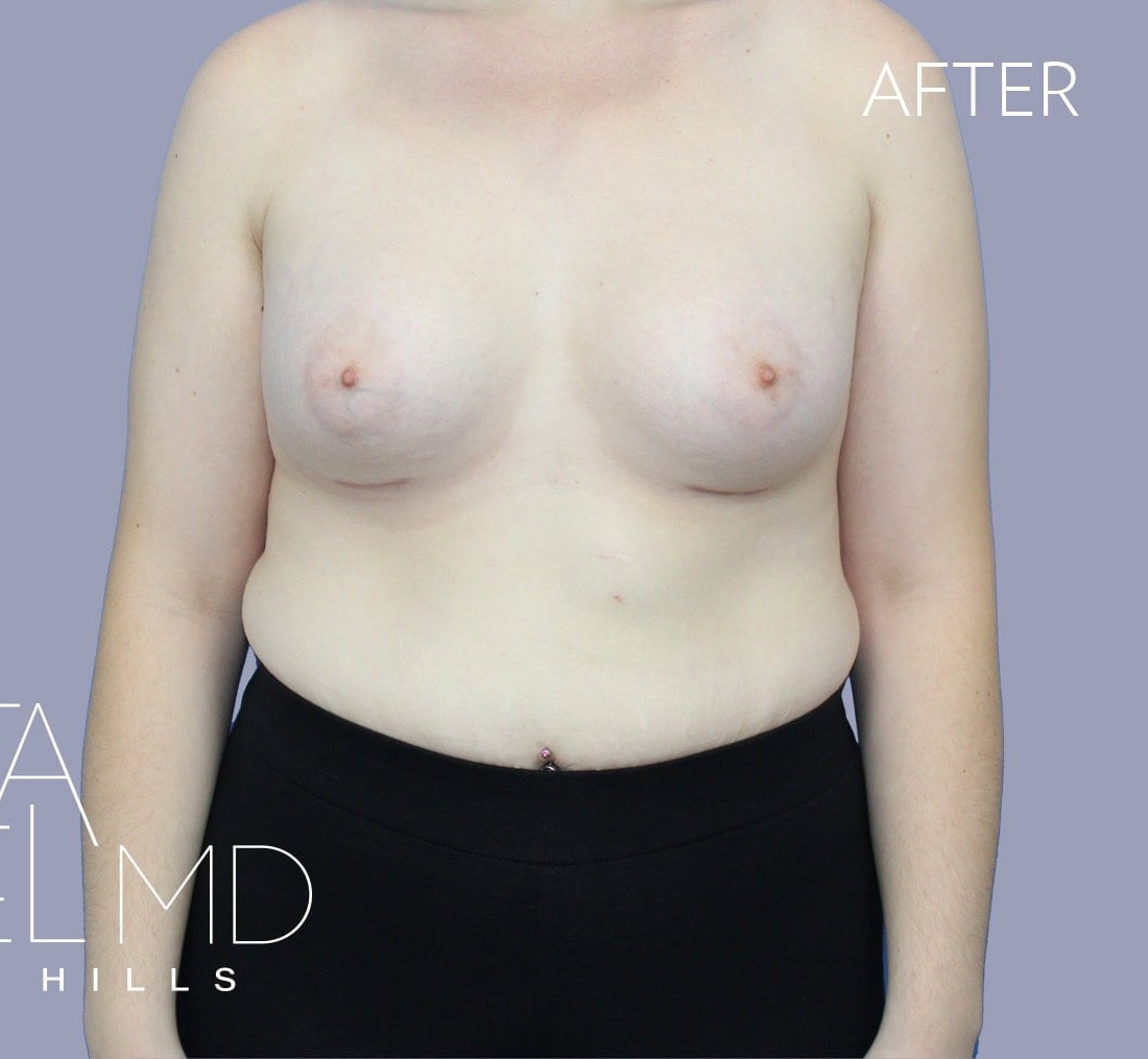 Breast Augmentation before and after - after