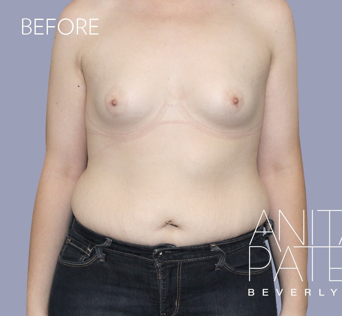 Breast Augmentation before and after - before