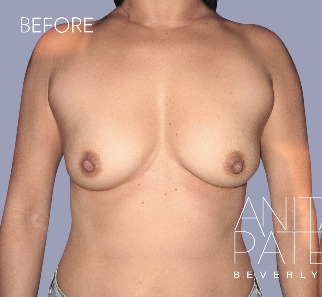 Breast Augmentation before and after - before