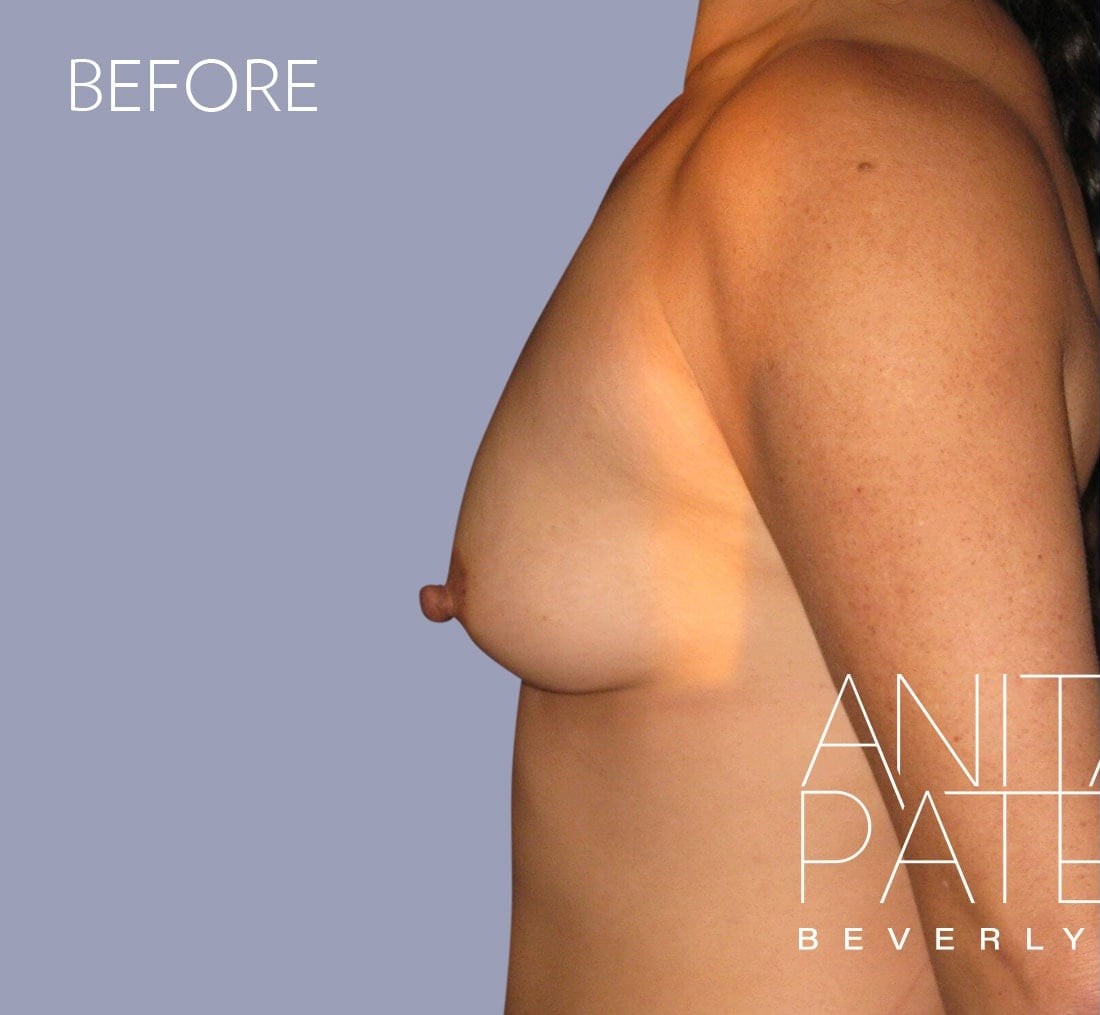 Breast Augmentation before and after - before