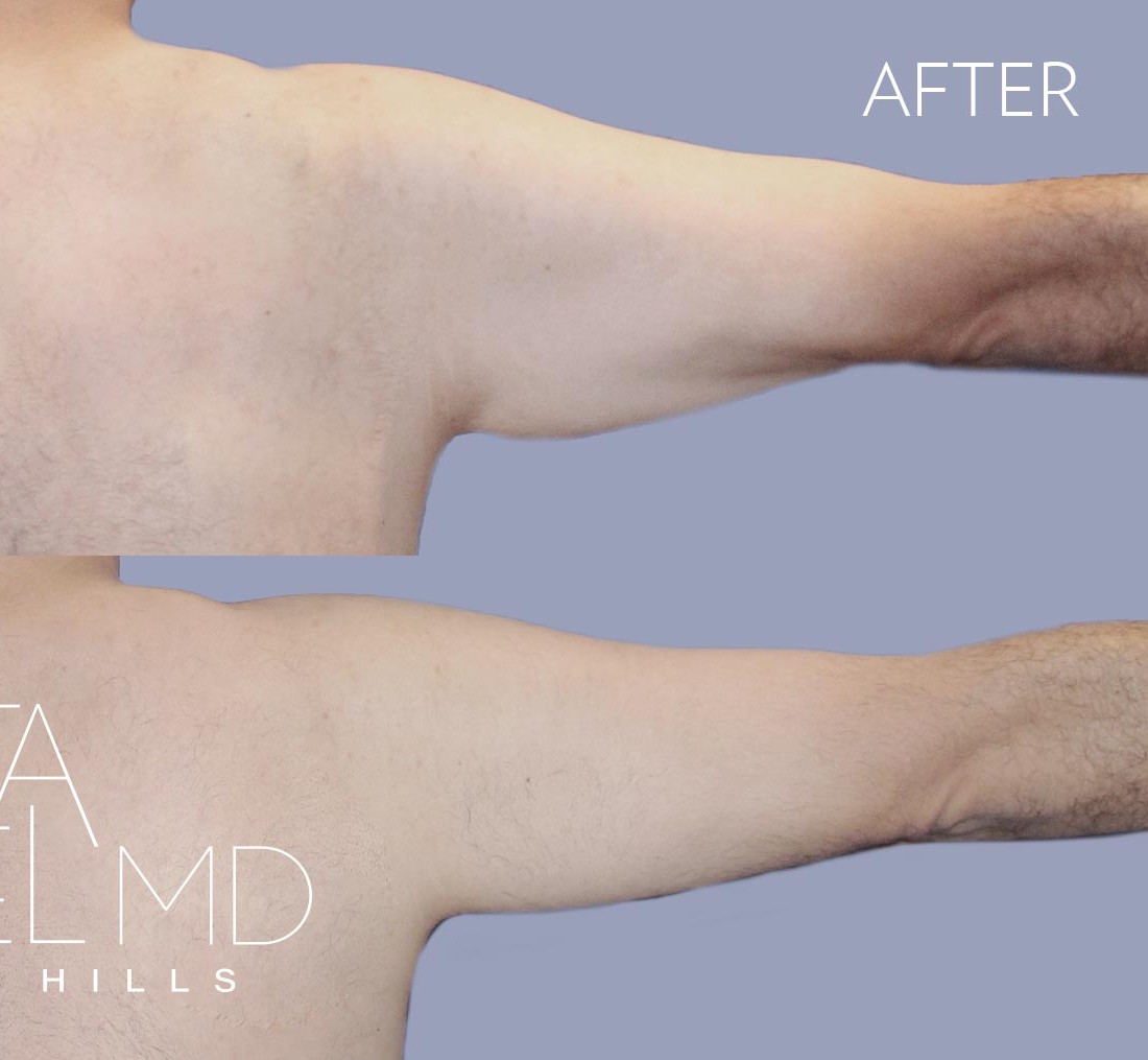 Arm Lift before and after - after