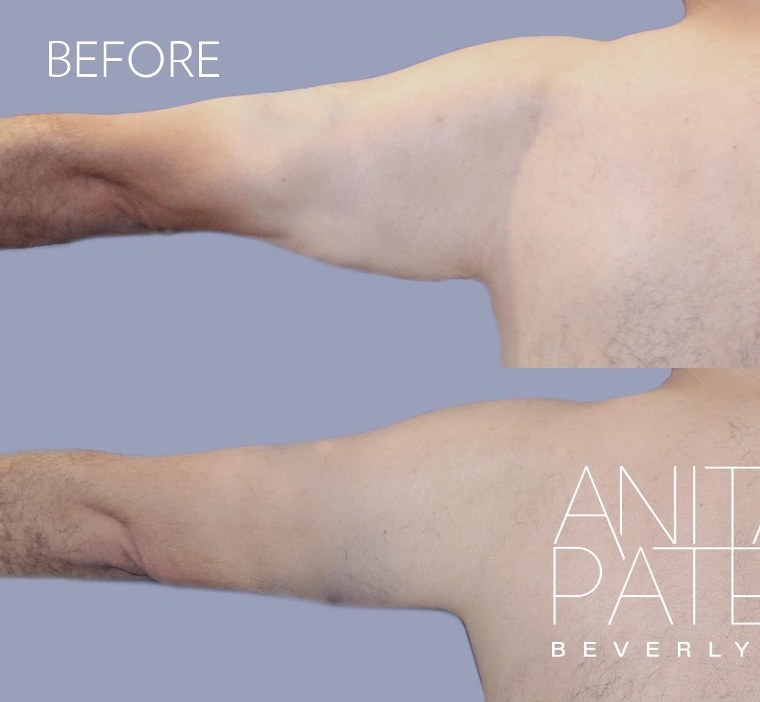 Arm Lift before and after - before