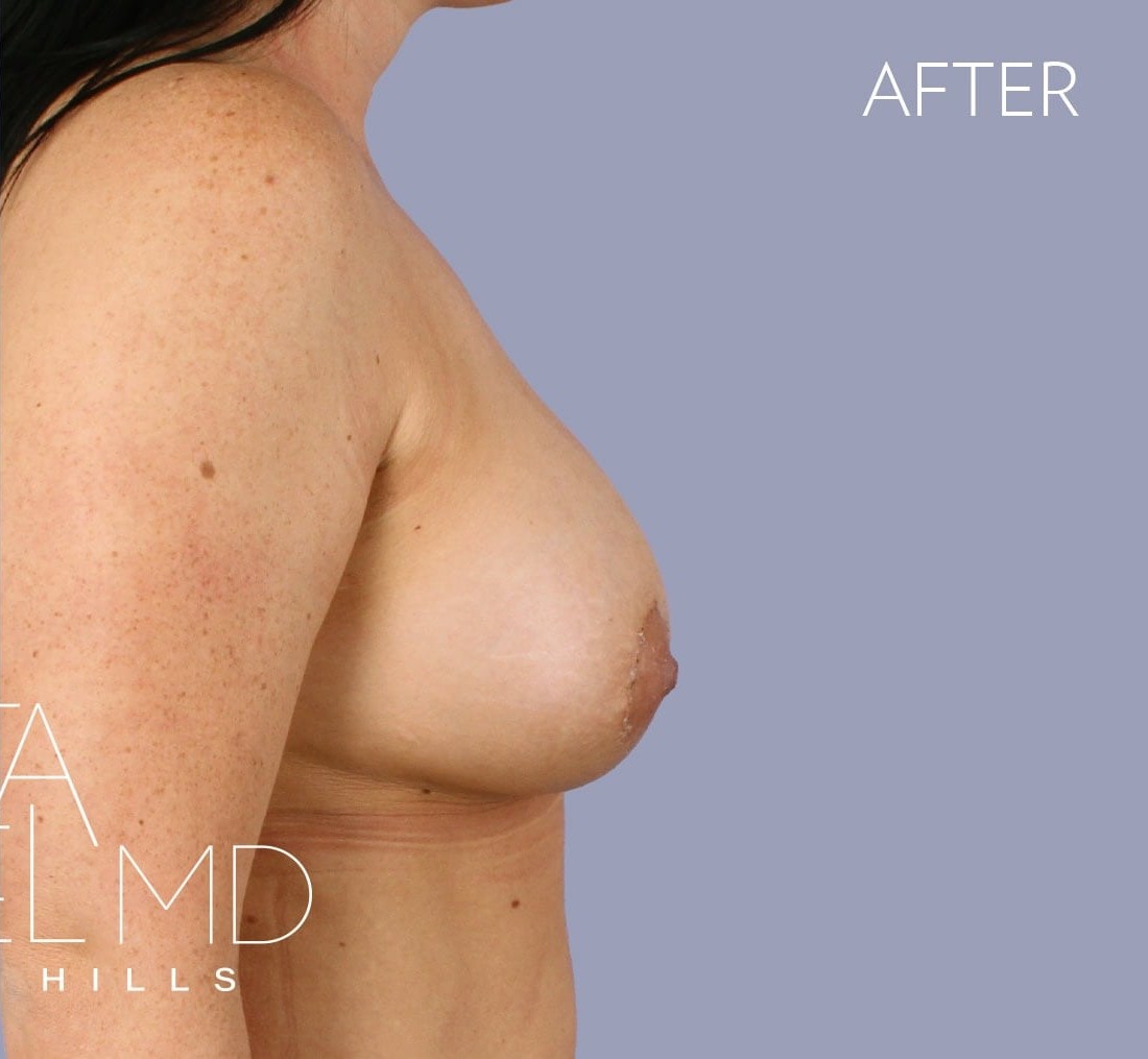 Breast Augmentation with Lift before and after - after