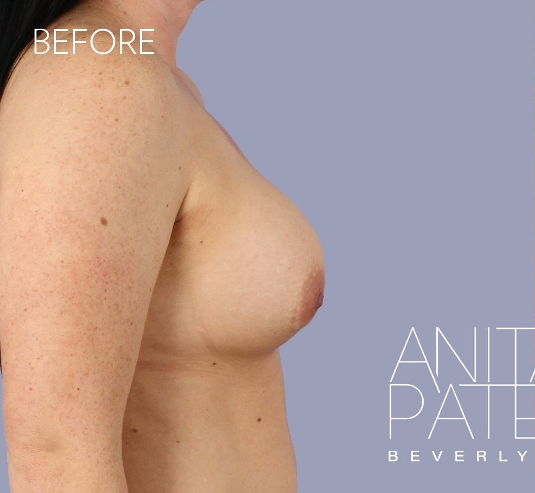 Breast Augmentation with Lift before and after - before