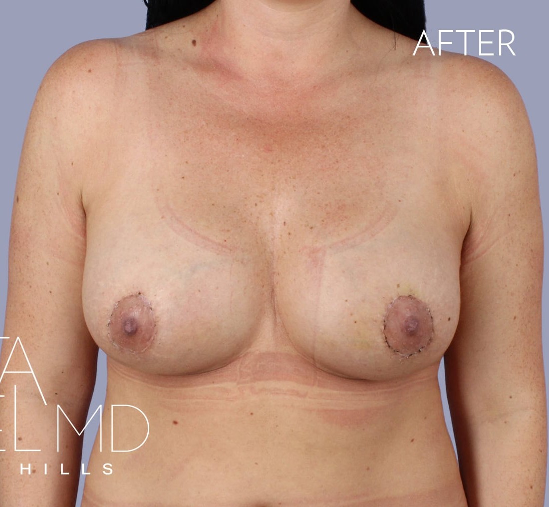 Breast Augmentation with Lift before and after - after