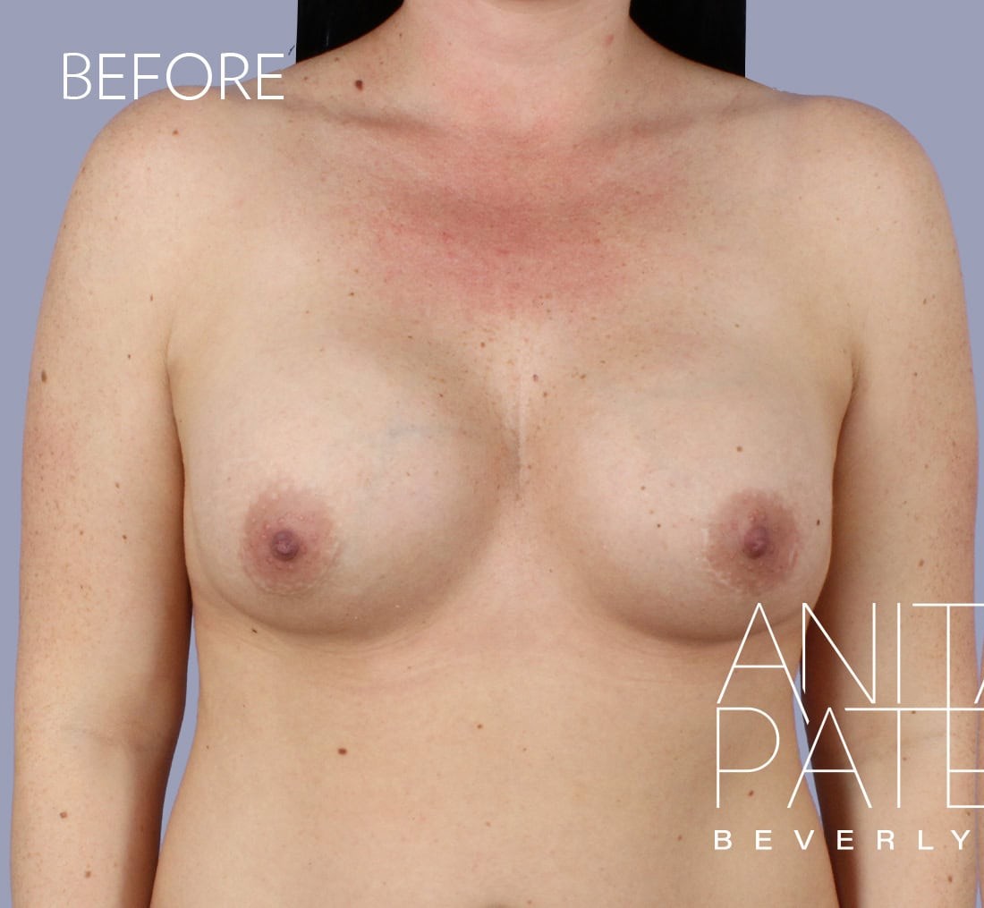 Breast Augmentation with Lift before and after - before