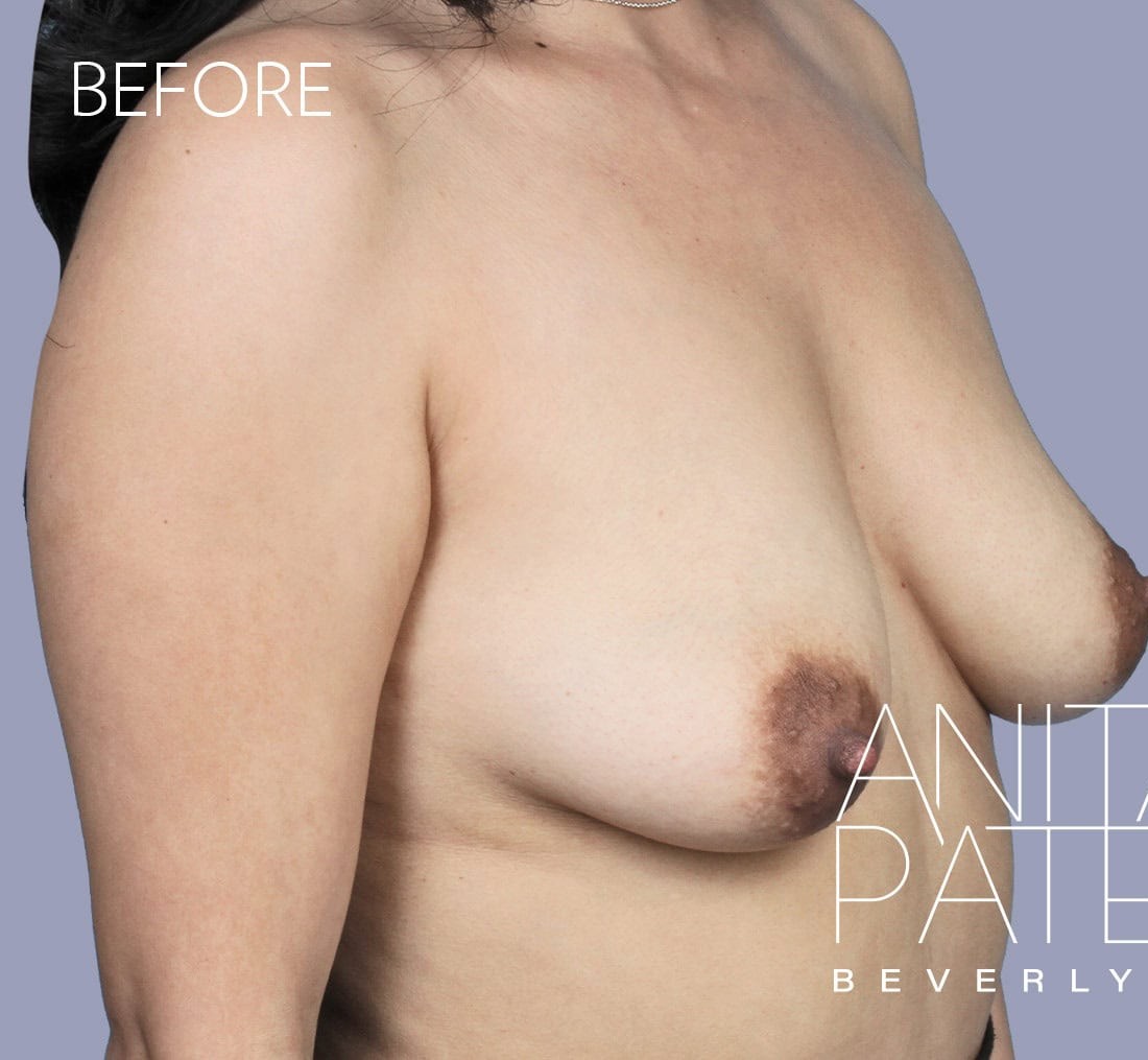 Breast Augmentation with Lift before and after - before